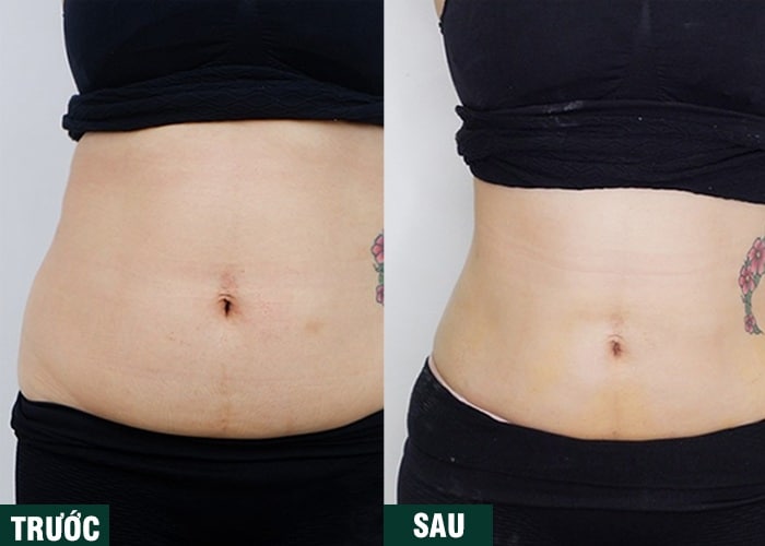 Ảnh kết quả thẩm mỹ