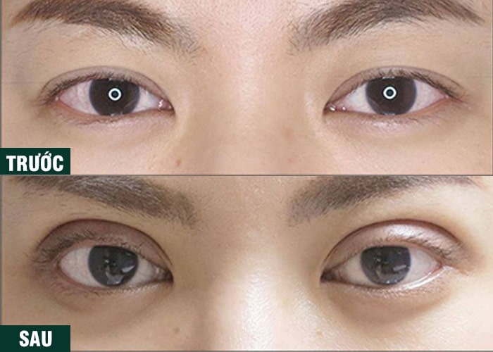 Ảnh kết quả thẩm mỹ