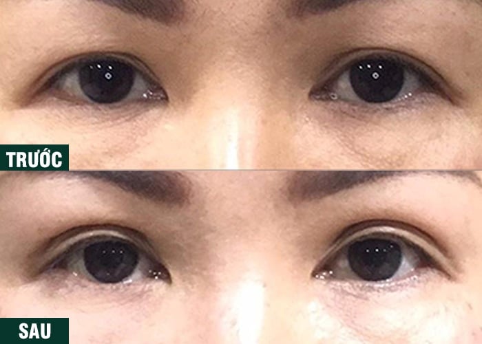 Ảnh kết quả thẩm mỹ