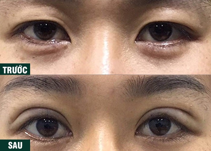 Ảnh kết quả thẩm mỹ