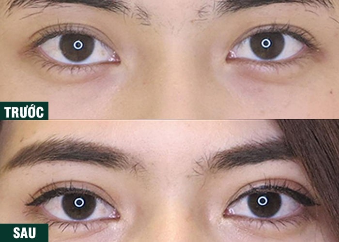 Ảnh kết quả thẩm mỹ