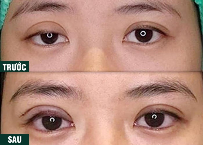 Ảnh kết quả thẩm mỹ