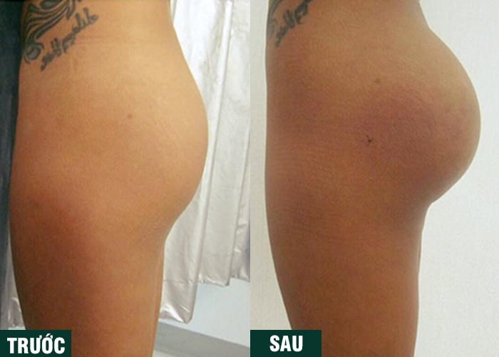 Ảnh kết quả thẩm mỹ