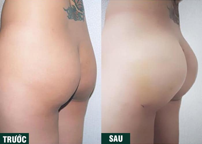 Ảnh kết quả thẩm mỹ