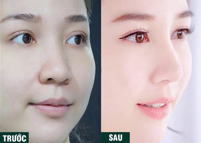 Ảnh kết quả thẩm mỹ