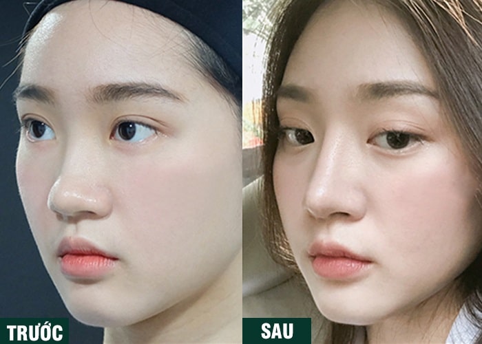 Ảnh kết quả thẩm mỹ