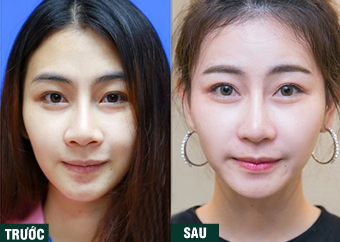 Ảnh kết quả thẩm mỹ