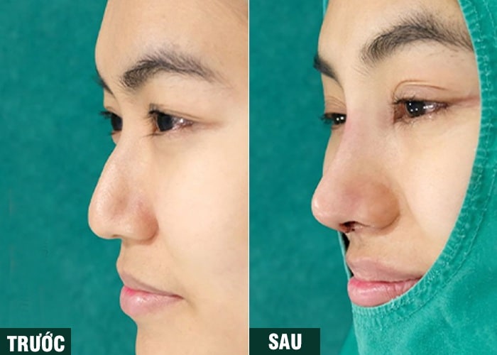 Ảnh kết quả thẩm mỹ